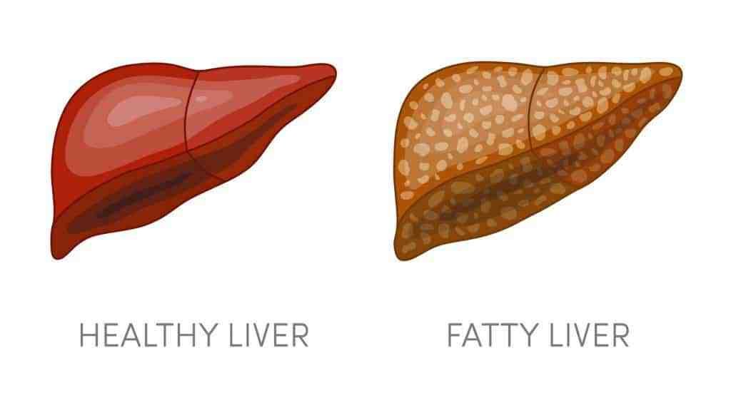 Fatty Liver Guide: A website to reverse liver diseases